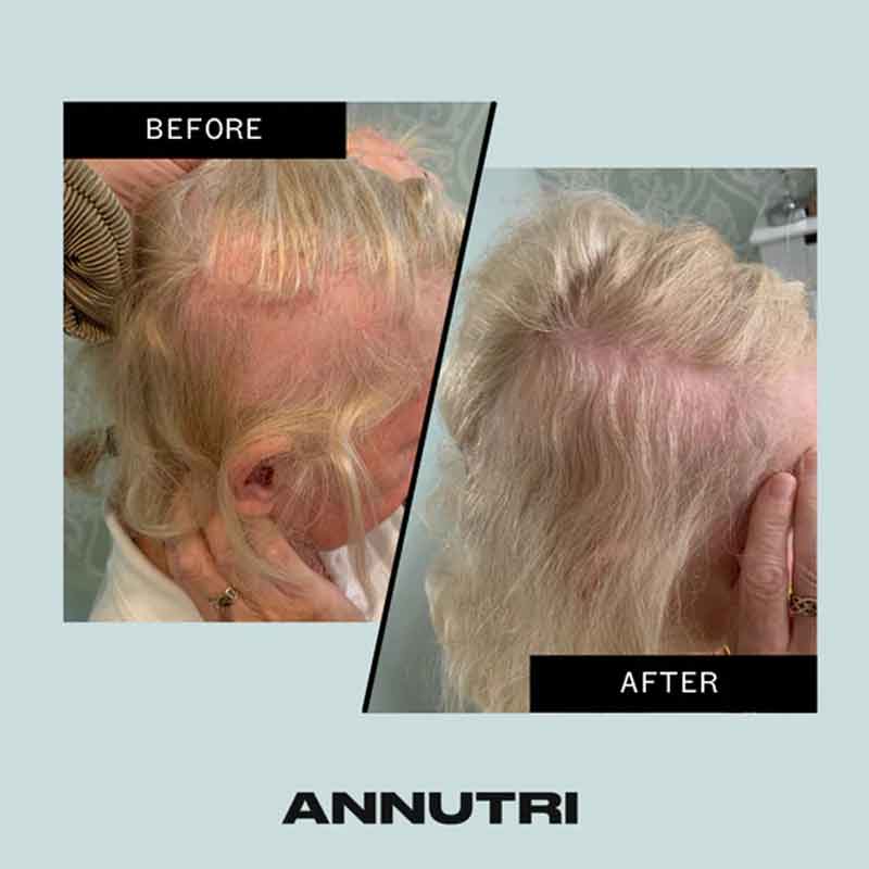 Annutri Grow It Hair Growth Supplement - 6 Month Supply